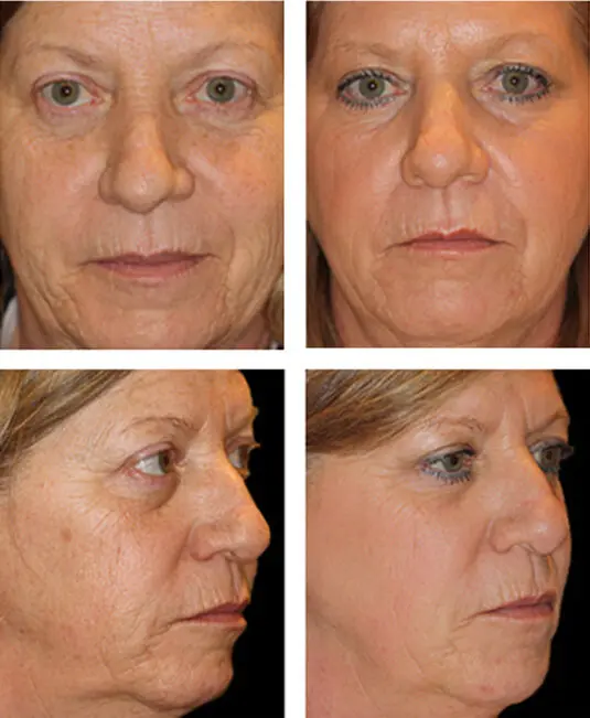 【2025 Guide】Laser Skin Resurfacing & Rejuvenation: Costs, Clinics, and Best Options in the U.S. 💎